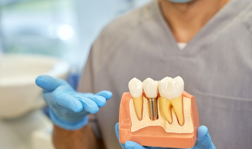 Implantes dentales