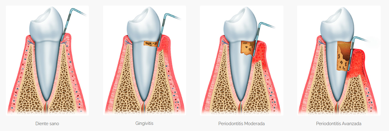 Proceso de un diente sano a un diente con periodoncia avanzada