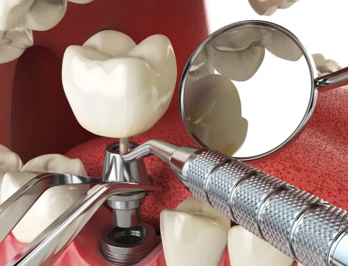 El proceso de colocación de implantes dentales: renueva tu sonrisa