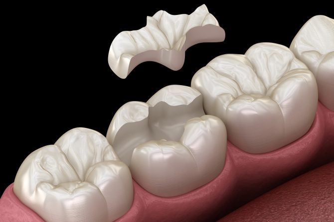 Incrustaciones dentales: restauración eficaz