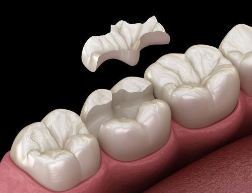 Incrustaciones dentales: restauración eficaz