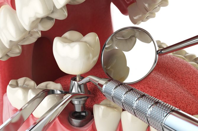 El proceso de colocación de implantes dentales: renueva tu sonrisa