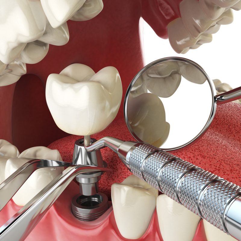 colocación implantes dentales